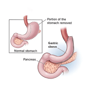 Bariatric surgery