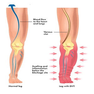 DVT