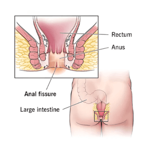 Fissure