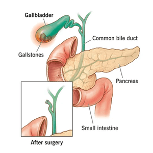 Gallstones