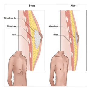 Gynaecomastia