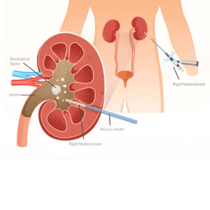 Kidney stones