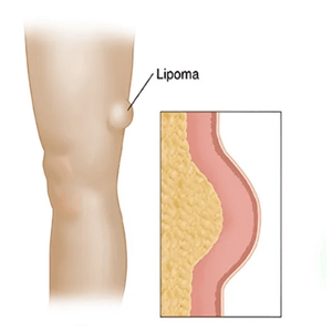 Lipoma surgery