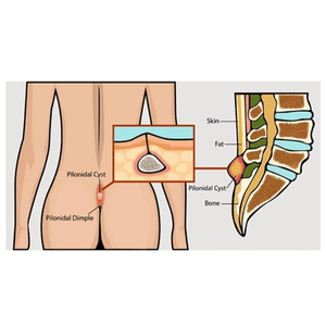 Pilonoidal