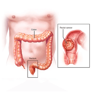 Rectal