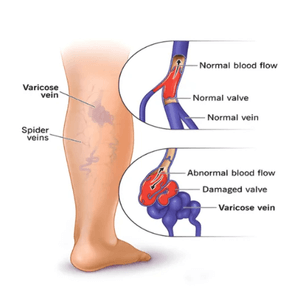 Varicose veins